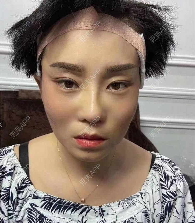 更美 - 洛丽塔洛丽塔的拉皮经验 | 郑州 | 拉皮