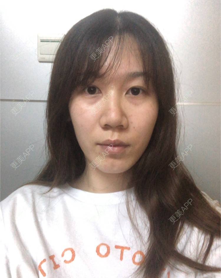 更美 - 更美用户AU4ZeikvFG的热玛吉经验 | 南宁 | 热玛吉