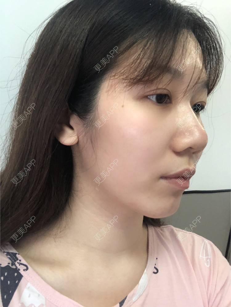 更美 - 更美用户AU4ZeikvFG的热玛吉经验 | 南宁 | 热玛吉