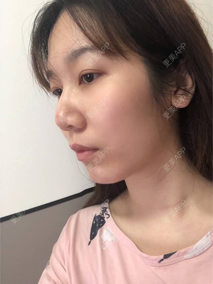 更美 - 更美用户AU4ZeikvFG的热玛吉经验 | 南宁 | 热玛吉