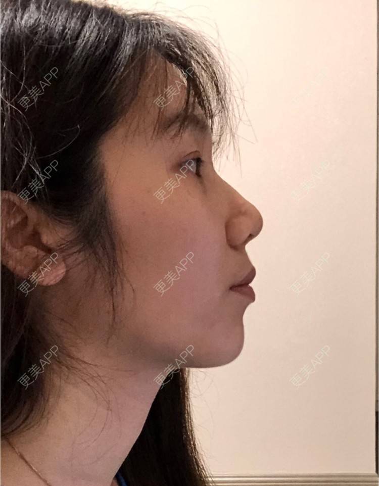 更美 - 更美用户AU4ZeikvFG的热玛吉经验 | 南宁 | 热玛吉