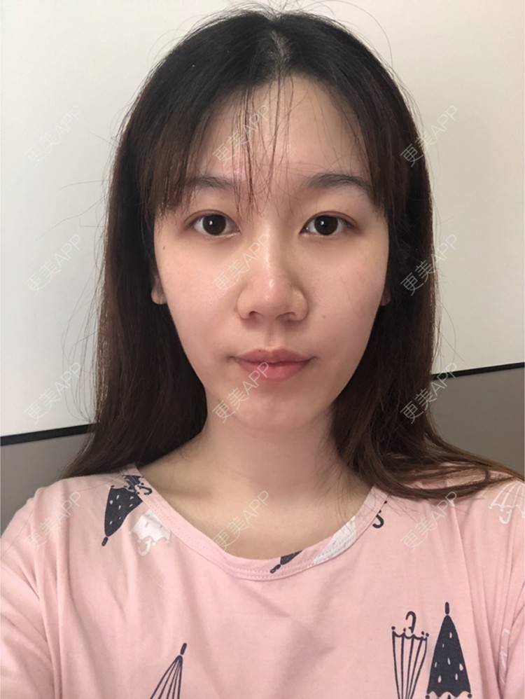 更美 - 更美用户AU4ZeikvFG的热玛吉经验 | 南宁 | 热玛吉