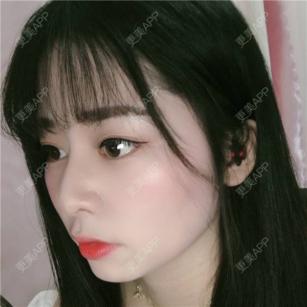 更美 - 更美用户TbWlVCTzIT的手术缩鼻头经验 | 视频日记 | 重庆 | 手术缩鼻头 | 鼻翼缩小 | 微晶瓷隆鼻