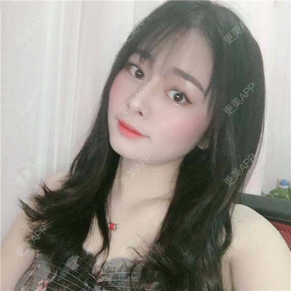 更美 - 更美用户TbWlVCTzIT的手术缩鼻头经验 | 视频日记 | 重庆 | 手术缩鼻头 | 鼻翼缩小 | 微晶瓷隆鼻