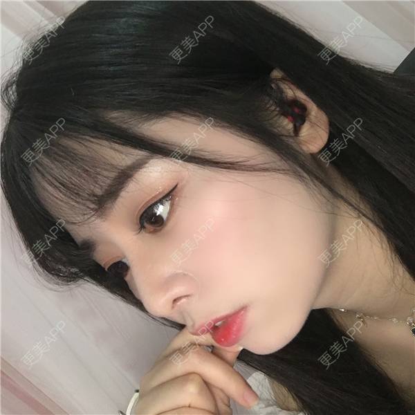 更美 - 更美用户TbWlVCTzIT的手术缩鼻头经验 | 视频日记 | 重庆 | 手术缩鼻头 | 鼻翼缩小 | 微晶瓷隆鼻