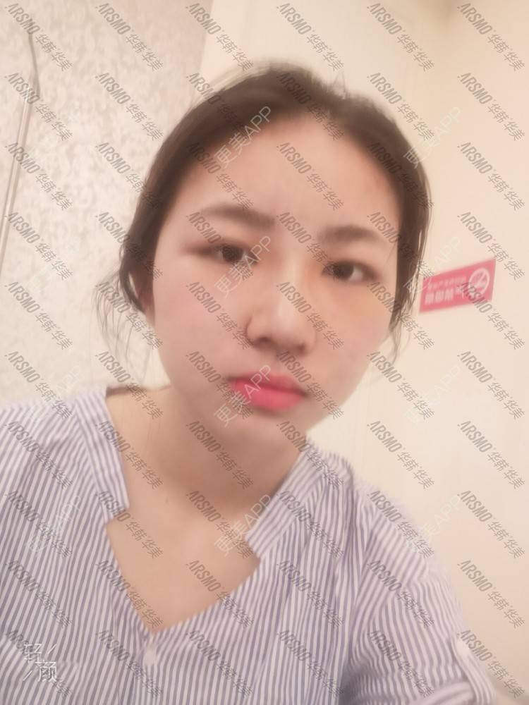 更美 - 加勒比海带Y的鼻部综合经验 | 人工骨隆鼻 | 肋软骨隆鼻 | 硅胶隆鼻 | 鼻部综合 | 鼻部修复 | 长沙