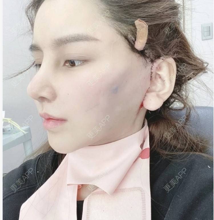 更美 - 66帅气的拉皮经验 | 郑州 | 拉皮