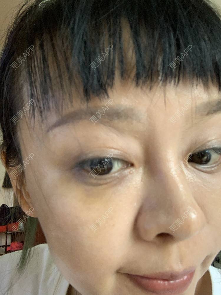 更美 - 衣衣丫丫的埋线提升经验 | 重庆 | 埋线提升