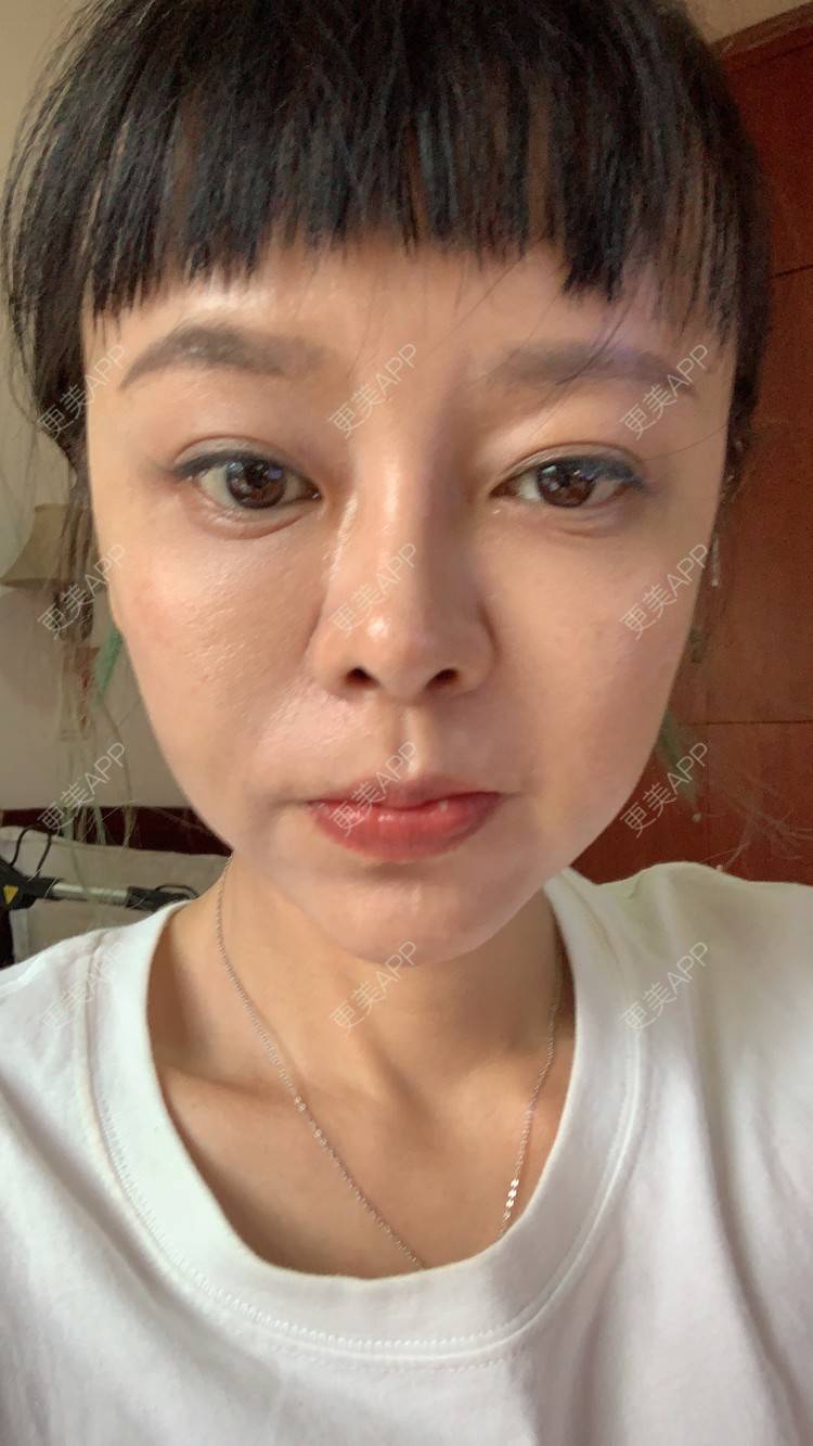 更美 - 衣衣丫丫的埋线提升经验 | 重庆 | 埋线提升