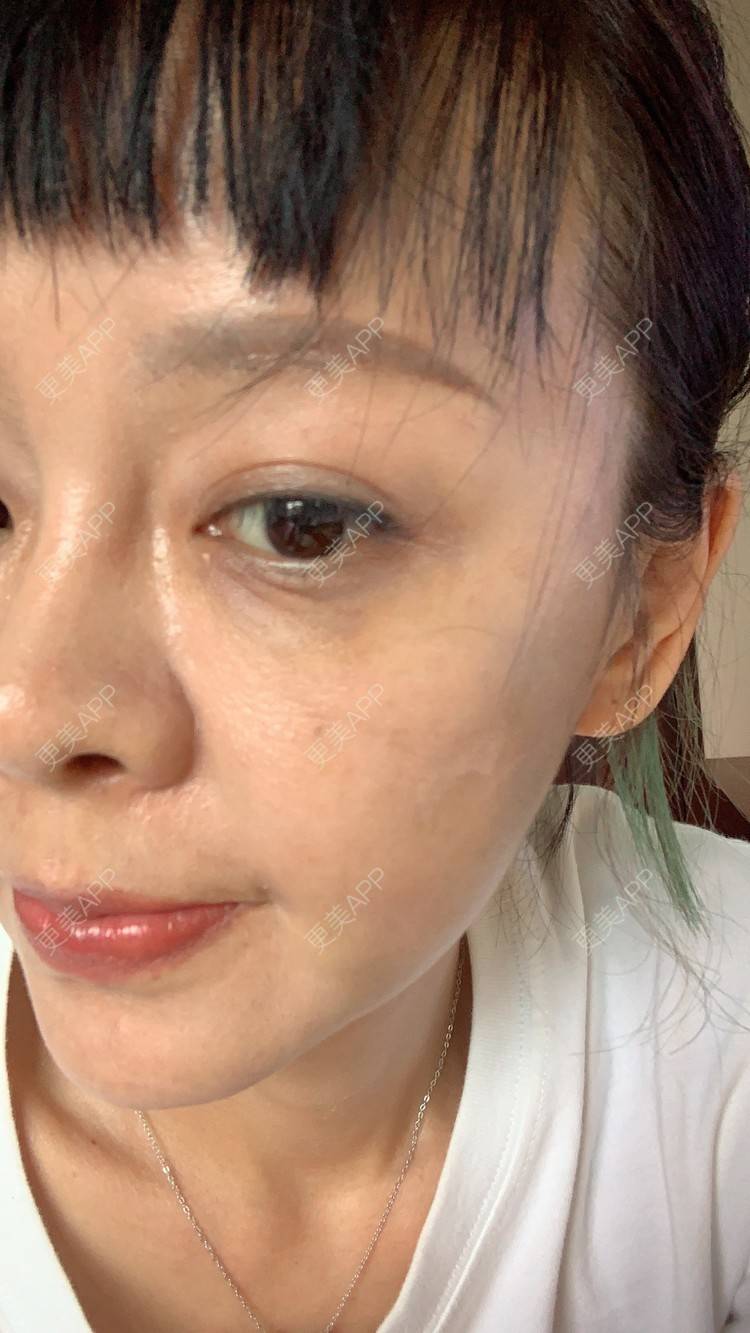 更美 - 衣衣丫丫的埋线提升经验 | 重庆 | 埋线提升