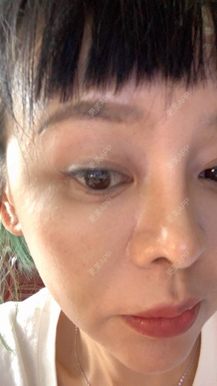 更美 - 衣衣丫丫的埋线提升经验 | 重庆 | 埋线提升