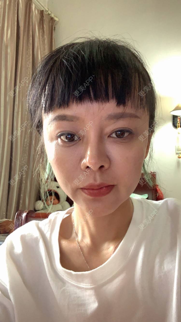 更美 - 衣衣丫丫的埋线提升经验 | 重庆 | 埋线提升