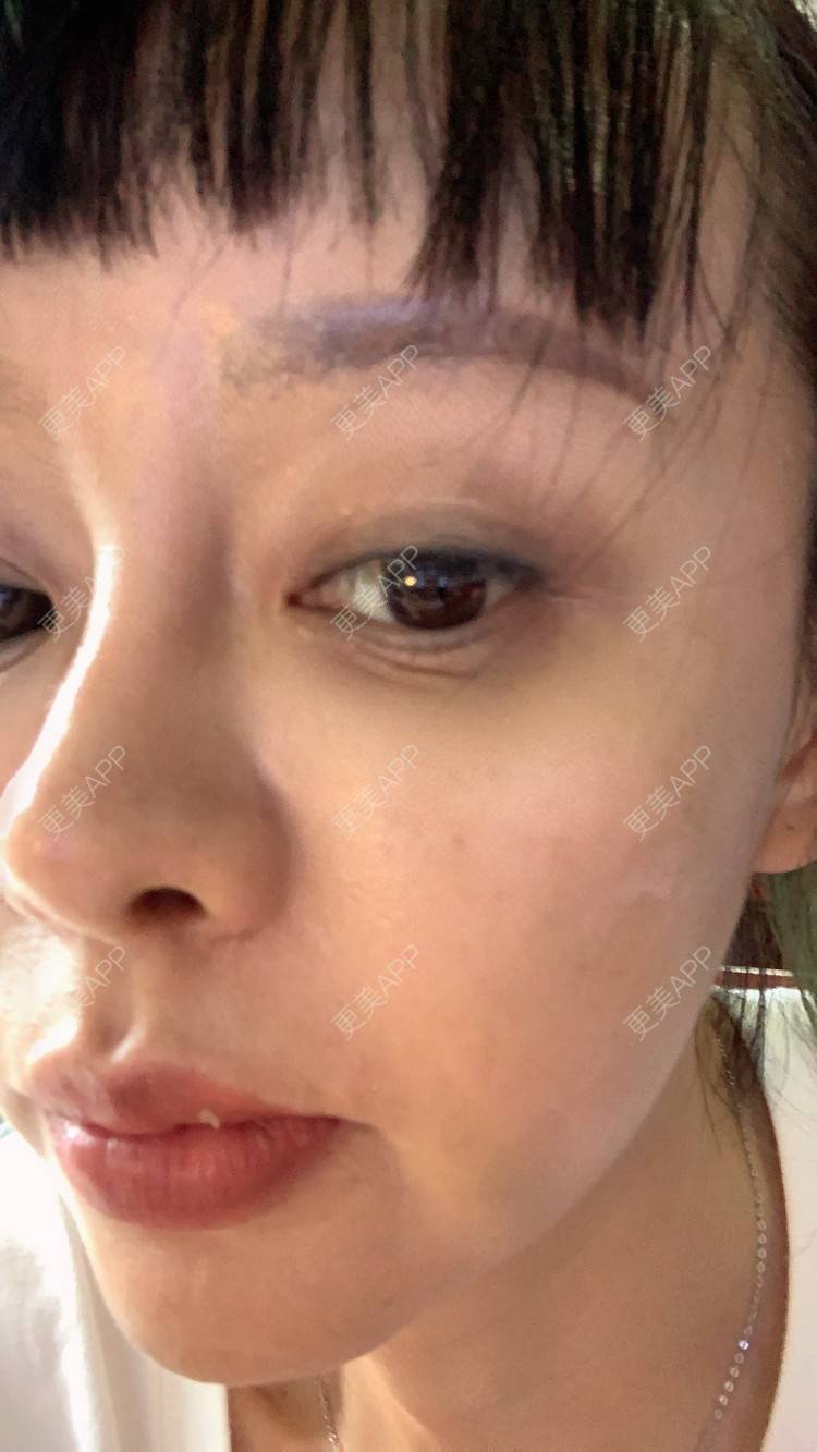 更美 - 衣衣丫丫的埋线提升经验 | 重庆 | 埋线提升