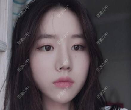 更美 - 更美用户4bynV2w0A2的鼻部多项经验 | 鼻部多项 | 武汉