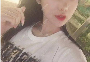 更美 - 丽丽聚说的玻尿酸下巴经验 | 更美研究所 | 注射美白 | 玻尿酸下巴 | 杭州