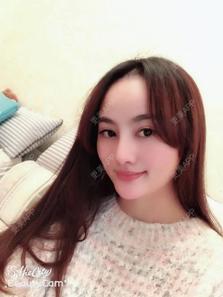 更美 - 更美用户tYzlahBO6T的植发际线经验 | 植发际线 | 深圳 | 毛发移植