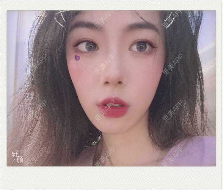 更美 - 痞子夺位先的隆鼻经验 | 隆鼻 | 无锡