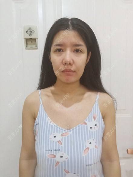 更美 - 更美用户4bynV2w0A2的假体隆胸经验 | 假体隆胸 | 武汉
