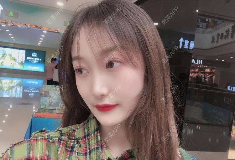 更美 - 更美用户Z3SjKafbbL的玻尿酸面颊经验 | 玻尿酸面颊