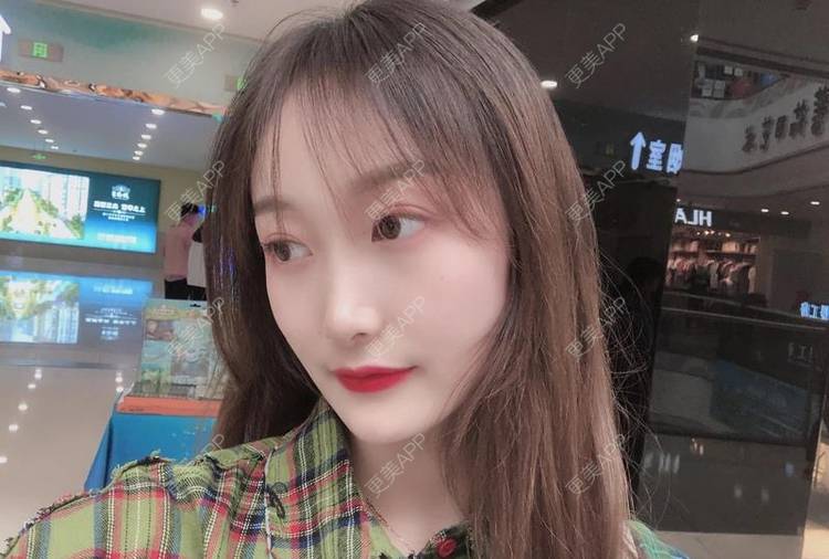 更美 - 更美用户Z3SjKafbbL的玻尿酸面颊经验 | 玻尿酸面颊