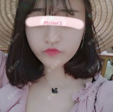 更美 - 小芒果蛋糕的玻尿酸下巴经验 | 更美研究所 | 杭州 | 玻尿酸下巴 | 玻尿酸