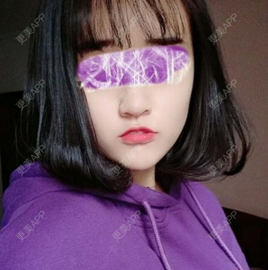 更美 - 小芒果蛋糕的玻尿酸下巴经验 | 更美研究所 | 杭州 | 玻尿酸下巴 | 玻尿酸