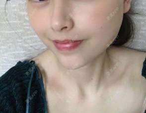 更美 - 阿个环境保护的玻尿酸下巴经验 | 更美研究所 | 杭州 | 玻尿酸下巴 | 玻尿酸