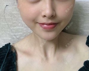 更美 - 阿个环境保护的玻尿酸下巴经验 | 更美研究所 | 杭州 | 玻尿酸下巴 | 玻尿酸