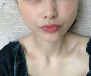 更美 - 阿个环境保护的玻尿酸下巴经验 | 更美研究所 | 杭州 | 玻尿酸下巴 | 玻尿酸