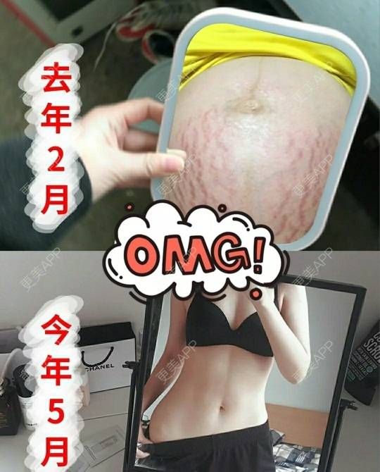 更美 - 更美用户BOYrmbtdLm的妊娠纹经验 | 上海 | 妊娠纹
