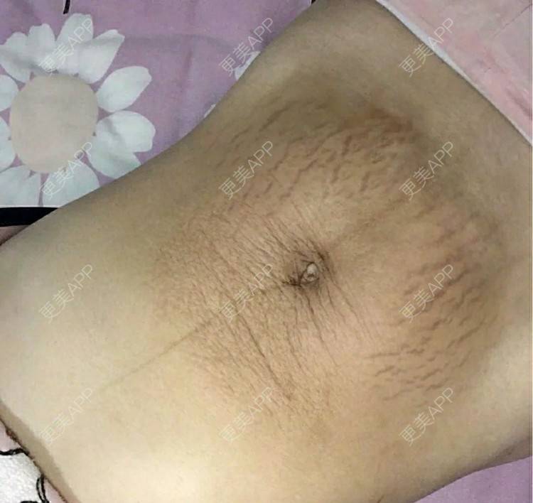 更美 - 更美用户k16I0WDwfO的妊娠纹经验 | 上海 | 妊娠纹