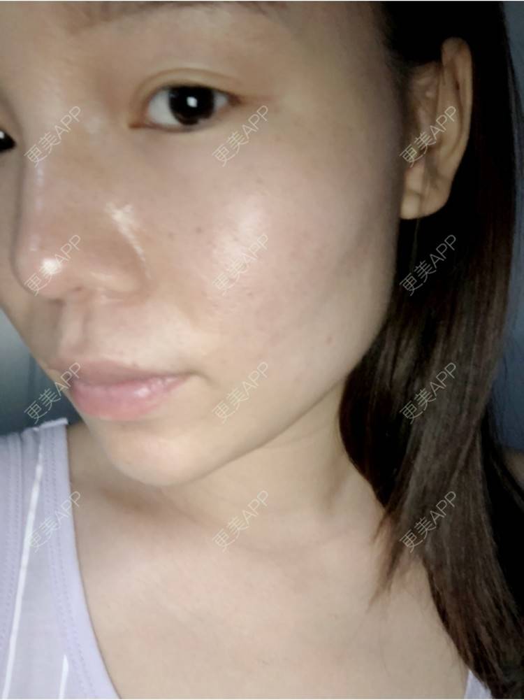 更美 - 旧时光是个大美人儿的除皱瘦脸经验 | 除皱瘦脸 | 玻尿酸下巴 | 杭州