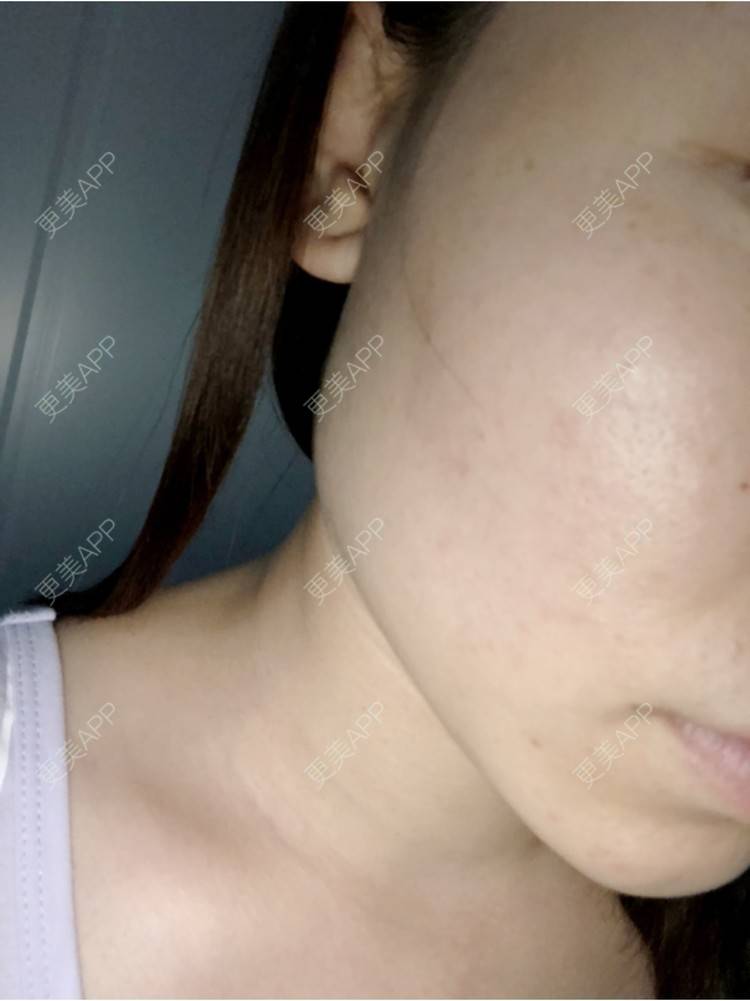 更美 - 旧时光是个大美人儿的除皱瘦脸经验 | 除皱瘦脸 | 玻尿酸下巴 | 杭州