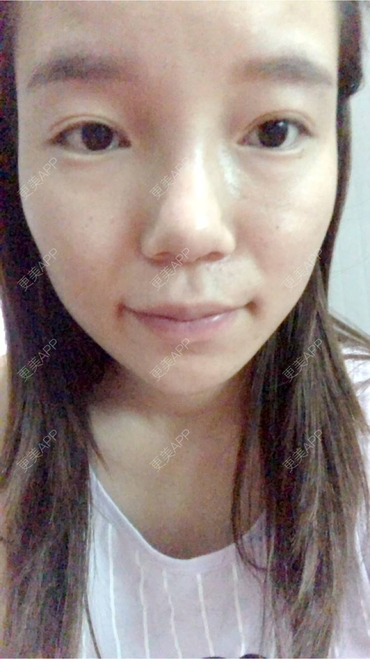 更美 - 旧时光是个大美人儿的除皱瘦脸经验 | 除皱瘦脸 | 玻尿酸下巴 | 杭州