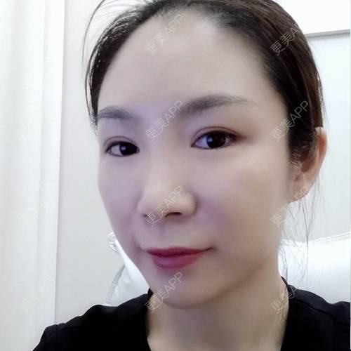更美 - 更美用户CDt3tU9VIP的玻尿酸鼻基底经验 | 玻尿酸下巴 | 玻尿酸鼻基底 | 玻尿酸 | 重庆
