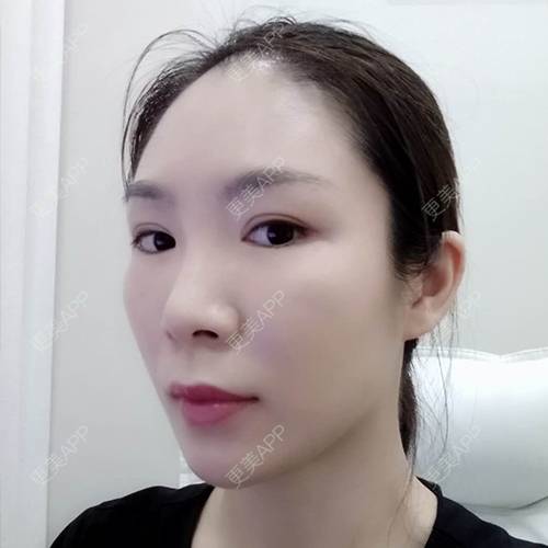 更美 - 更美用户CDt3tU9VIP的玻尿酸鼻基底经验 | 玻尿酸下巴 | 玻尿酸鼻基底 | 玻尿酸 | 重庆