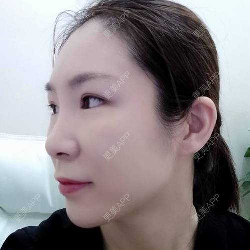 更美 - 更美用户CDt3tU9VIP的玻尿酸鼻基底经验 | 玻尿酸下巴 | 玻尿酸鼻基底 | 玻尿酸 | 重庆