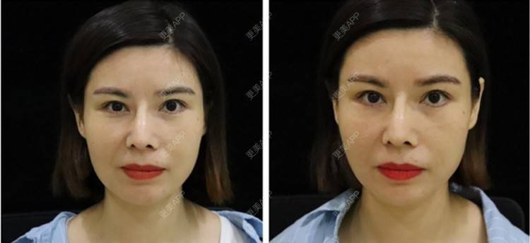 更美 - 更美用户mSvANk3xSG的热玛吉经验 | 深圳 | 热玛吉