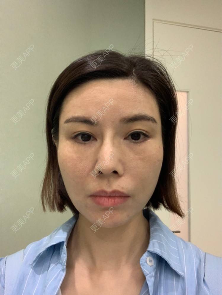 更美 - 更美用户mSvANk3xSG的热玛吉经验 | 深圳 | 热玛吉