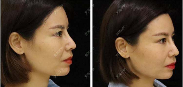 更美 - 更美用户mSvANk3xSG的热玛吉经验 | 深圳 | 热玛吉