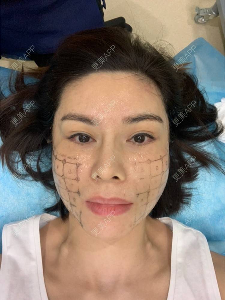 更美 - 更美用户mSvANk3xSG的热玛吉经验 | 深圳 | 热玛吉