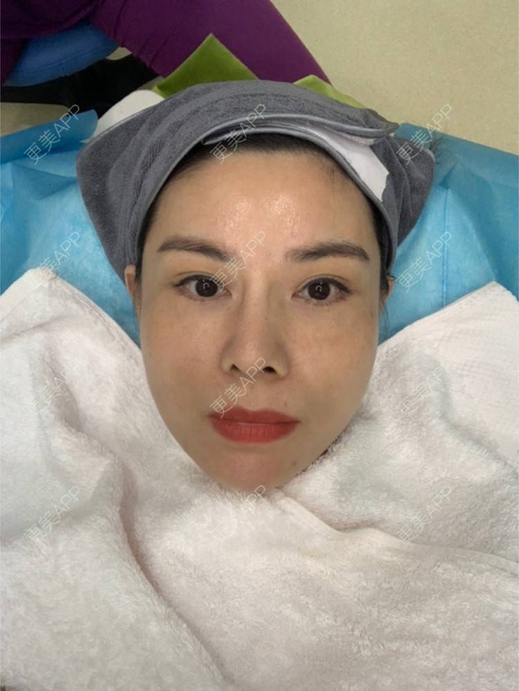 更美 - 更美用户mSvANk3xSG的热玛吉经验 | 深圳 | 热玛吉