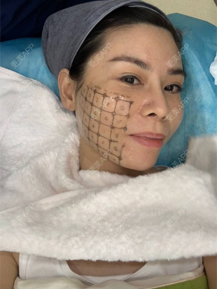 更美 - 更美用户mSvANk3xSG的热玛吉经验 | 深圳 | 热玛吉