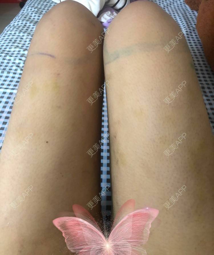 更美 - 更美用户JjeRai1vC1的吸脂瘦大腿经验 | 吸脂瘦大腿 | 吸脂塑臀 | 青岛