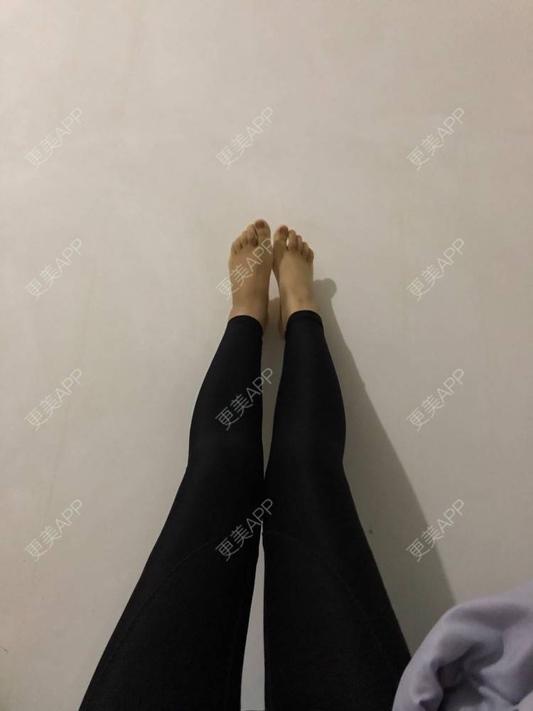更美 - 更美用户JjeRai1vC1的吸脂瘦大腿经验 | 吸脂瘦大腿 | 吸脂塑臀 | 青岛