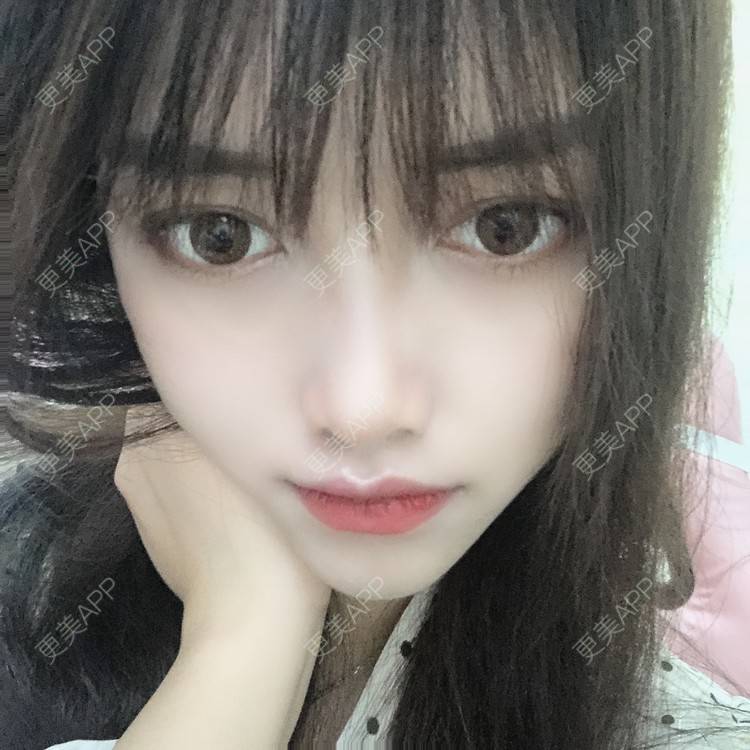 更美 - 敬来远之_ぐ椎的颧骨提高经验 | 颧骨提高 | 轮廓修复术 | 颧弓降低 | 下颌角切除 | 成都