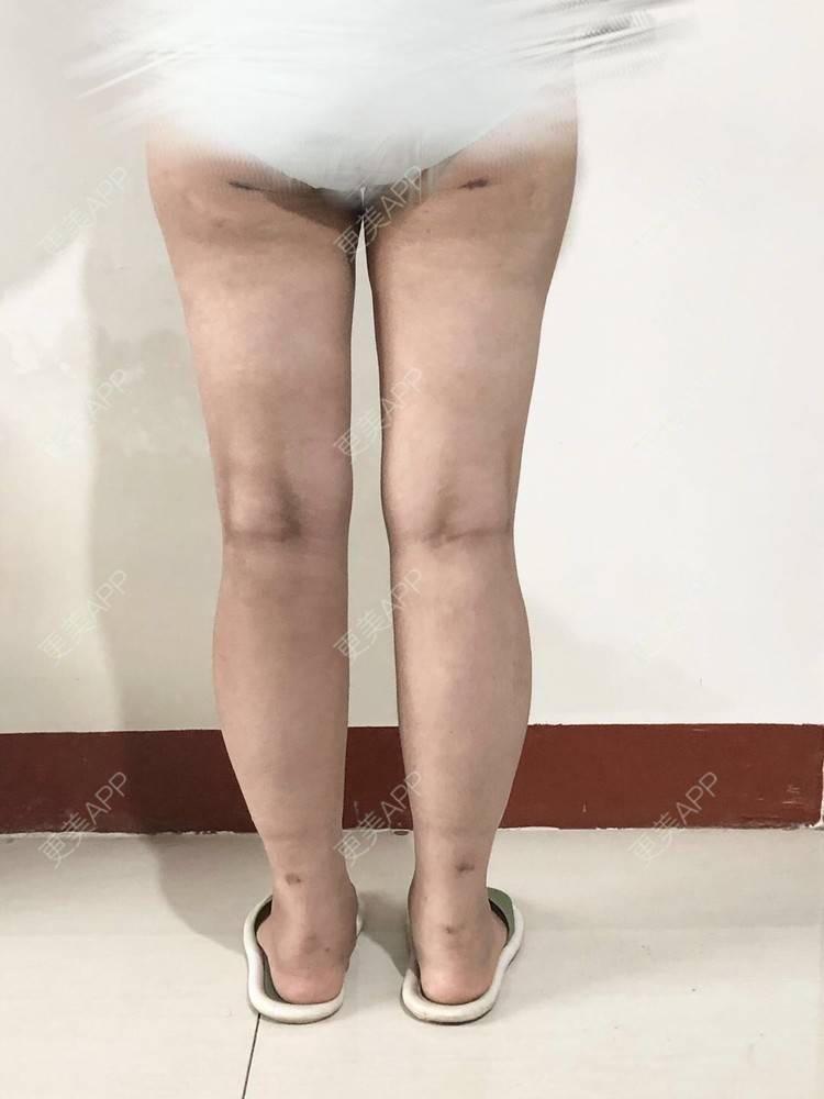 更美 - 更美用户JjeRai1vC1的吸脂瘦大腿经验 | 吸脂瘦大腿 | 吸脂塑臀 | 青岛