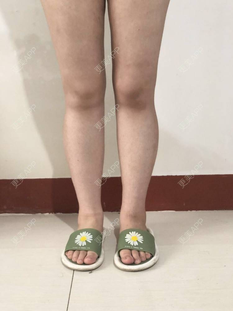 更美 - 更美用户JjeRai1vC1的吸脂瘦大腿经验 | 吸脂瘦大腿 | 吸脂塑臀 | 青岛