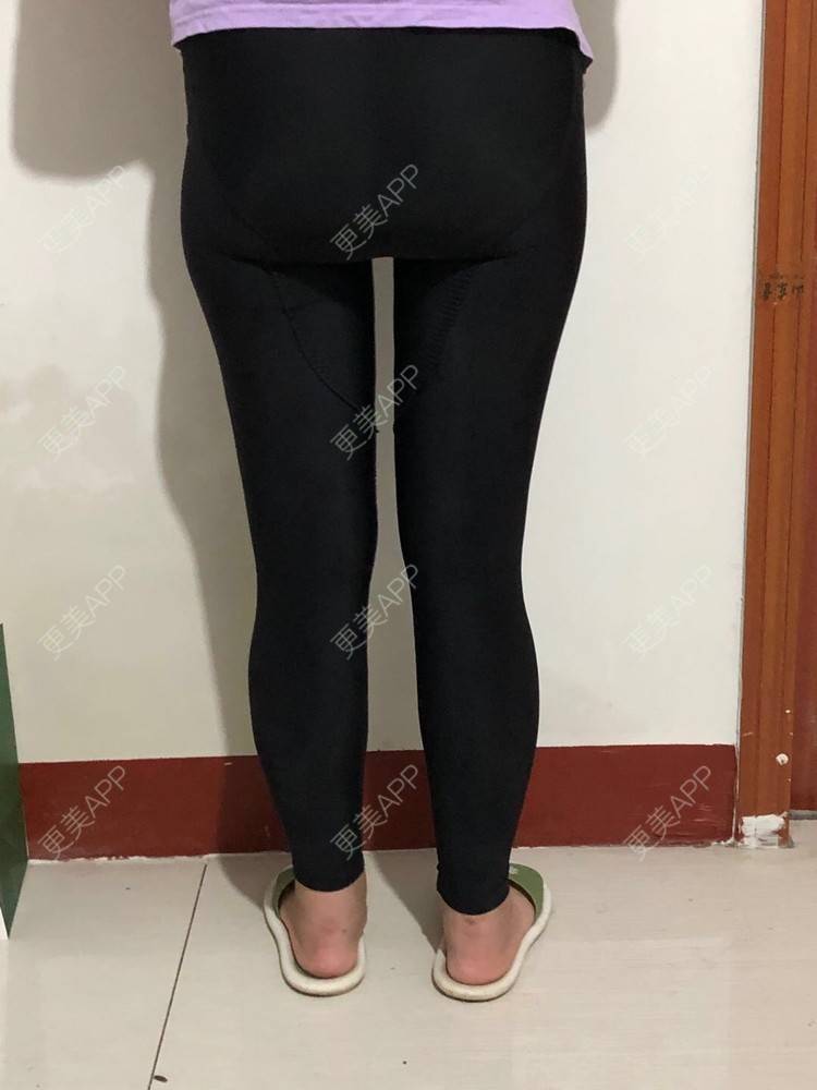 更美 - 更美用户JjeRai1vC1的吸脂瘦大腿经验 | 吸脂瘦大腿 | 吸脂塑臀 | 青岛