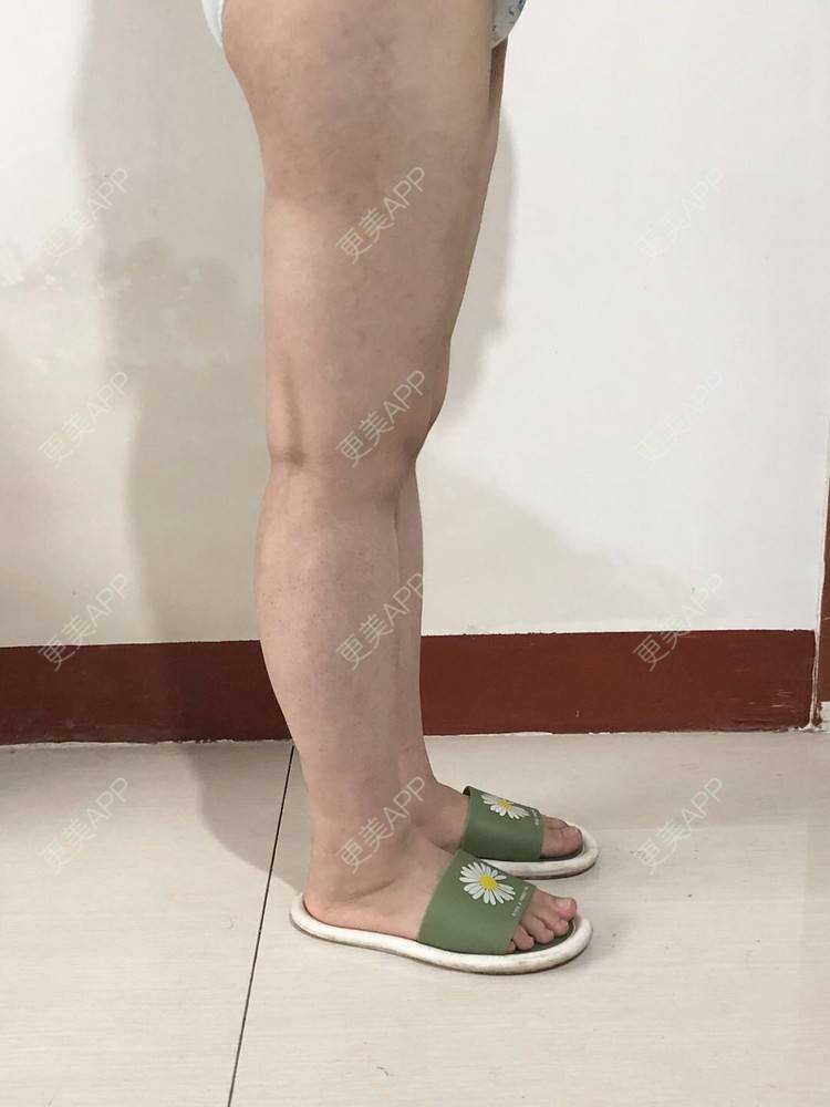 更美 - 更美用户JjeRai1vC1的吸脂瘦大腿经验 | 吸脂瘦大腿 | 吸脂塑臀 | 青岛